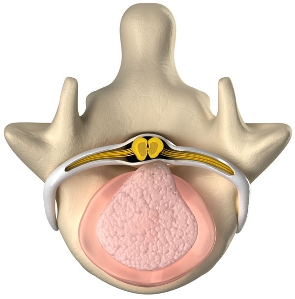Bulging Disc